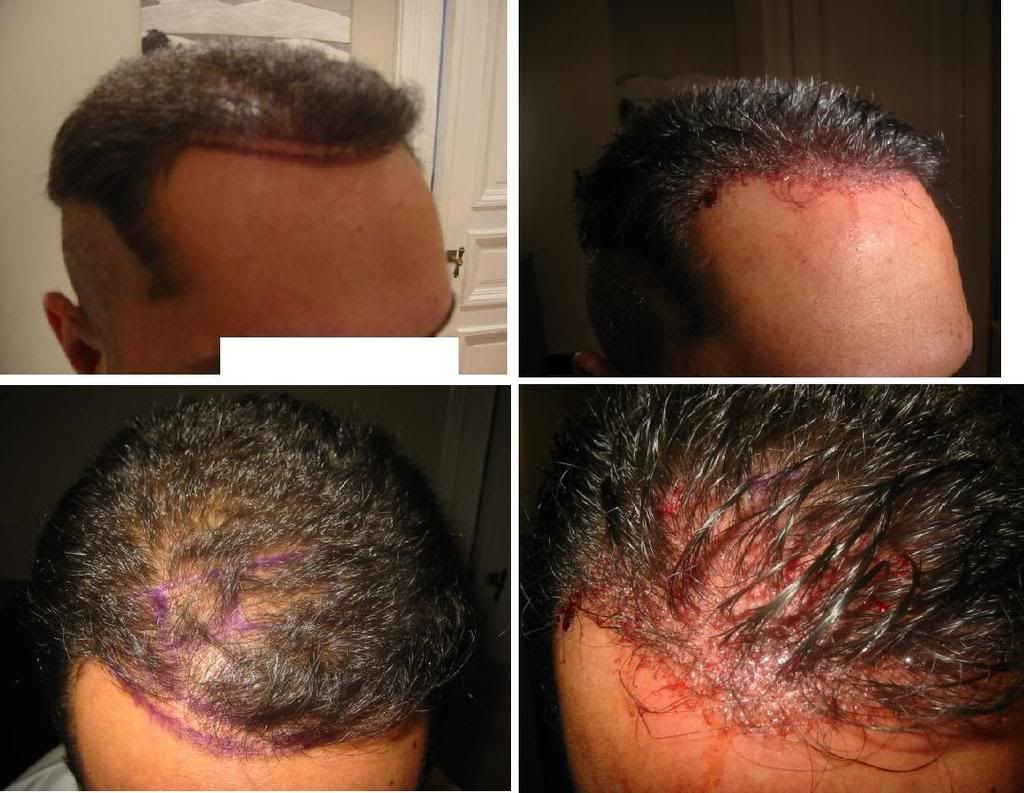 http://i156.photobucket.com/albums/t23/BHRClinic/1200%20FUE/1200FUEDesignPlacement.jpg