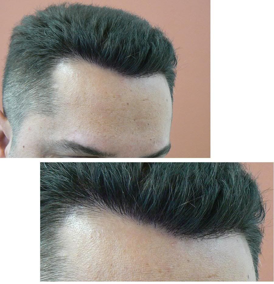 http://i156.photobucket.com/albums/t23/BHRClinic/1200%20FUE/P1050651.jpg