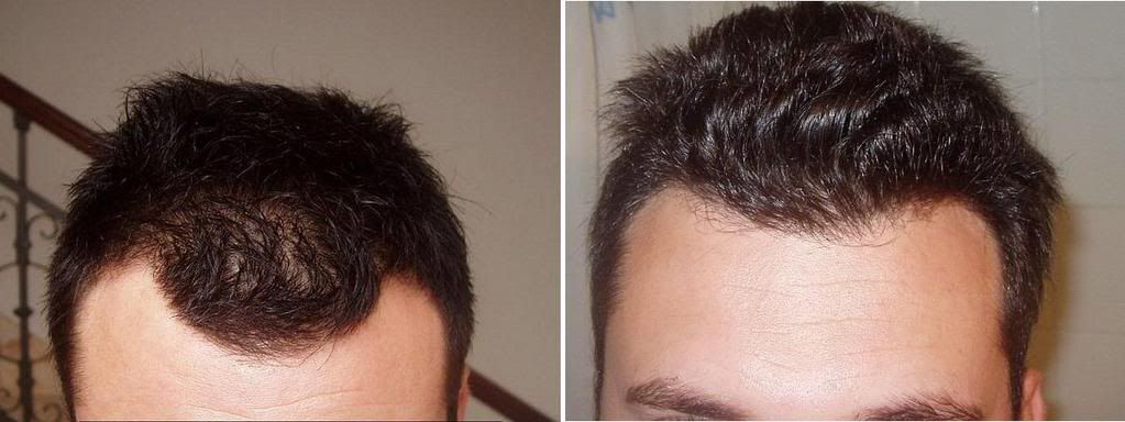 http://i156.photobucket.com/albums/t23/BHRClinic/1495%20FUE/before6Monthscomparrison.jpg