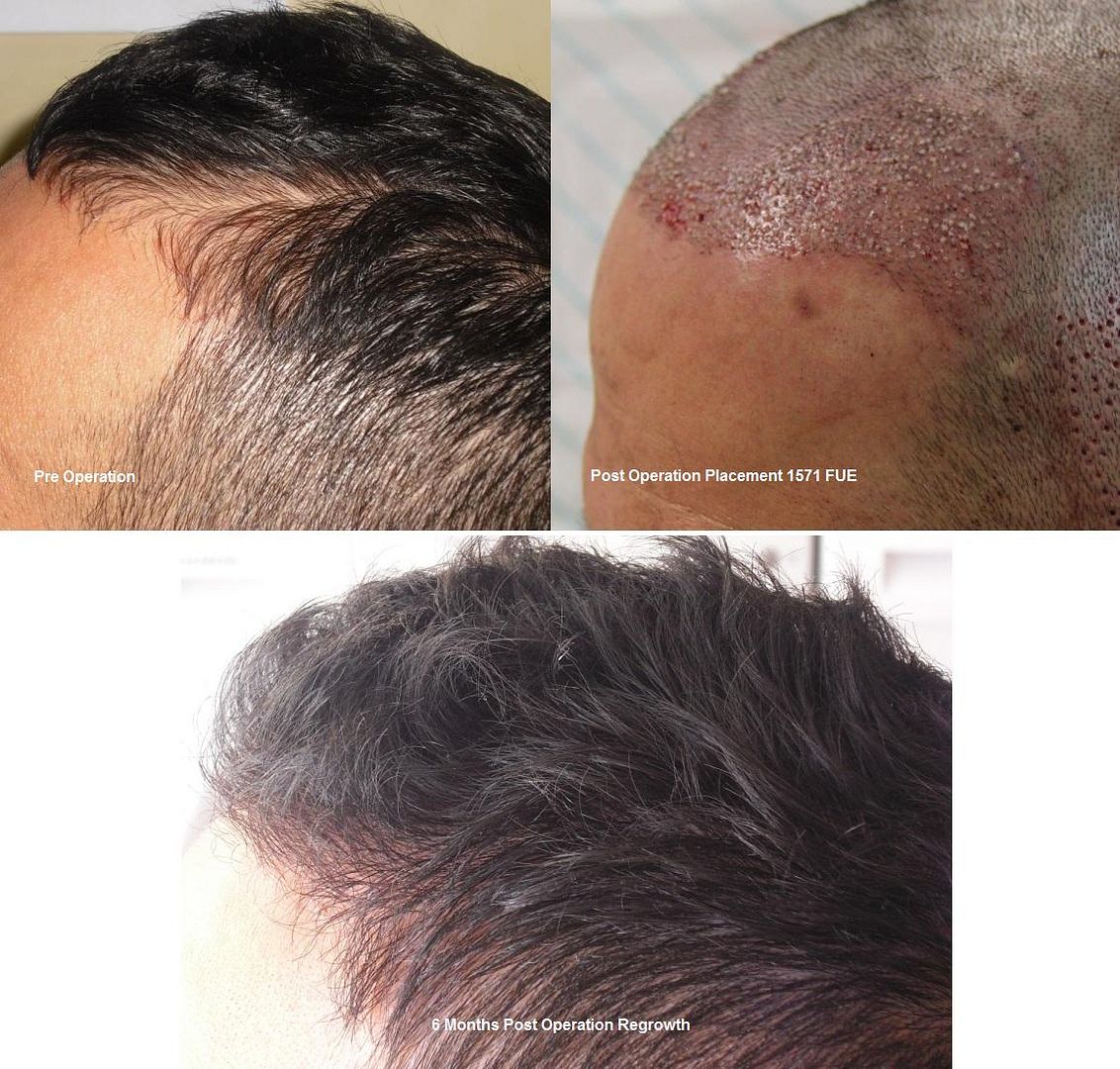 http://i156.photobucket.com/albums/t23/BHRClinic/1571%20FUE/1571FUE0-6Months.jpg