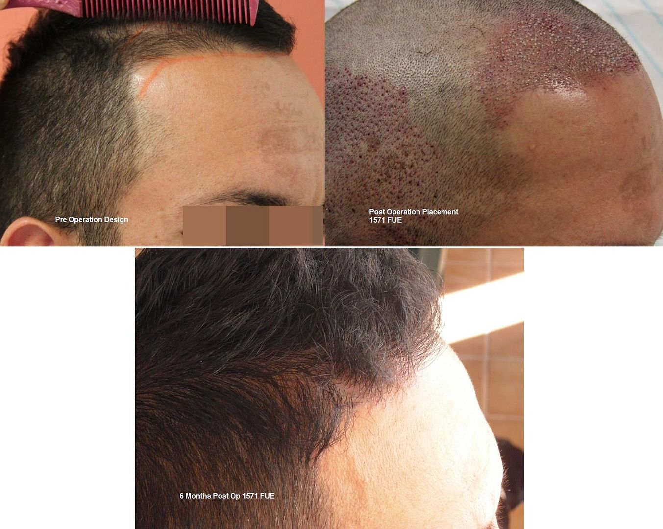 http://i156.photobucket.com/albums/t23/BHRClinic/1571%20FUE/1571FUE0-6Months2.jpg