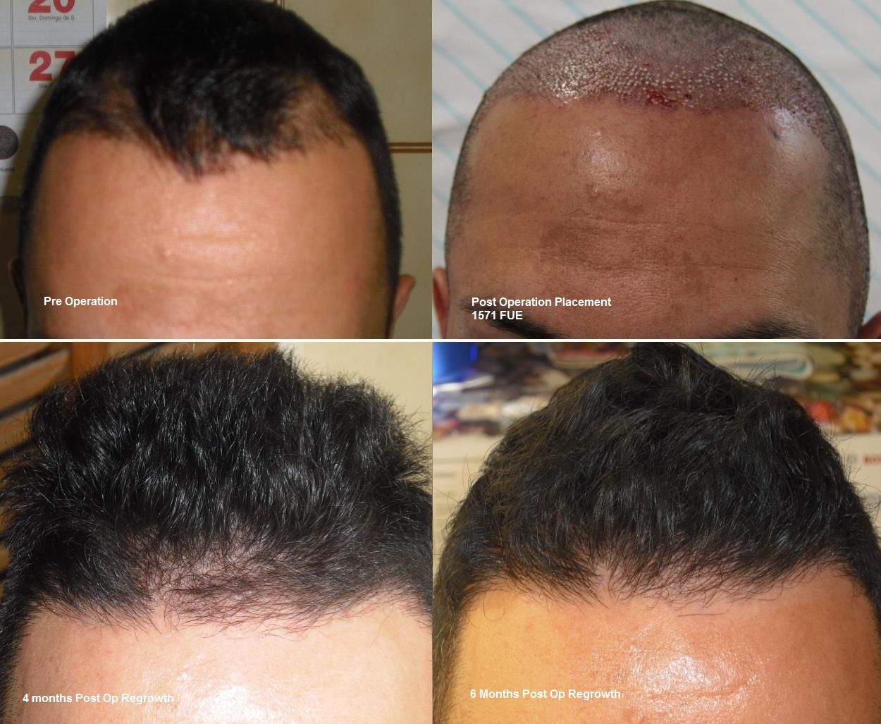 http://i156.photobucket.com/albums/t23/BHRClinic/1571%20FUE/1571FUE0-6Months3.jpg