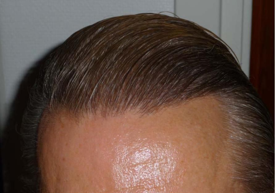 http://i156.photobucket.com/albums/t23/BHRClinic/1744%20FUE/9months3.jpg