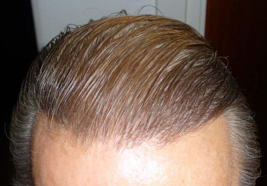 http://i156.photobucket.com/albums/t23/BHRClinic/1744%20FUE/9months4.jpg