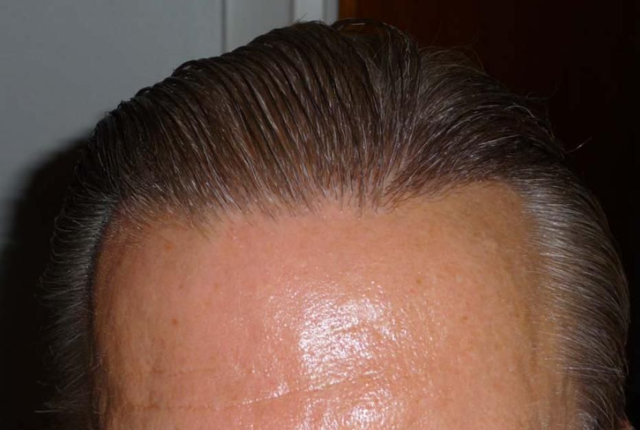 http://i156.photobucket.com/albums/t23/BHRClinic/1744%20FUE/9months6.jpg