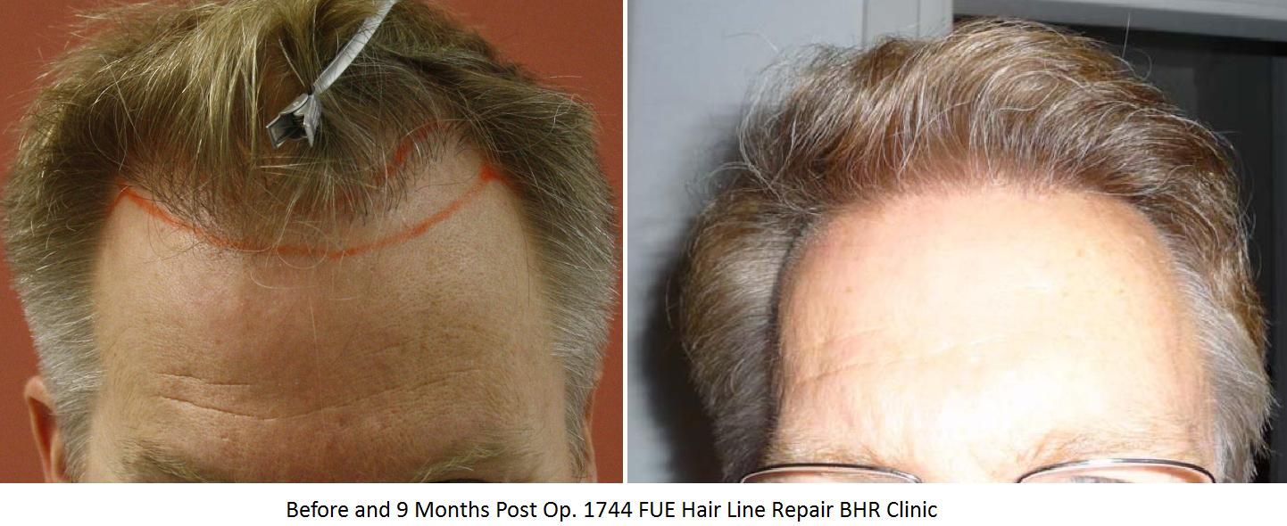 Beforeand9MonthsPostOp1744FUEHairLineRepairBHRClinic.jpg