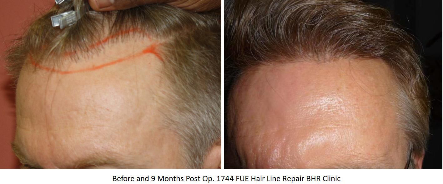 Beforeand9MonthsPostOp1744FUEHairLineRepairBHRClinic2.jpg