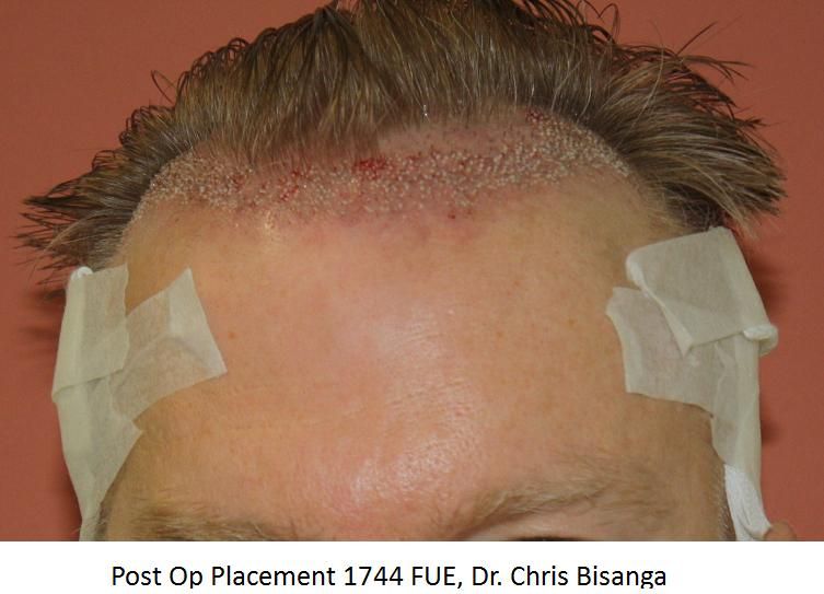 http://i156.photobucket.com/albums/t23/BHRClinic/1744%20FUE/PostOpPlacement1744FUEDrChrisBisanga.jpg