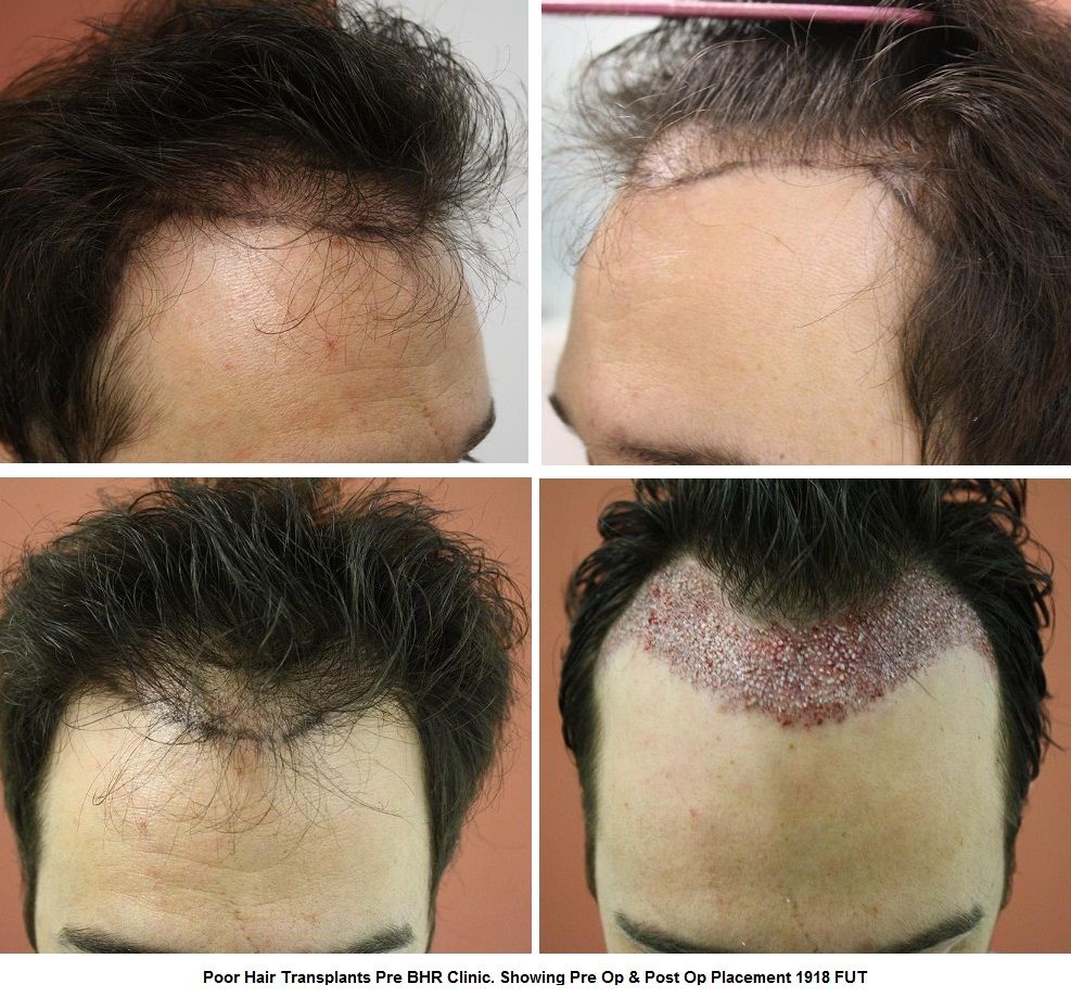 Fut Hair Transplant