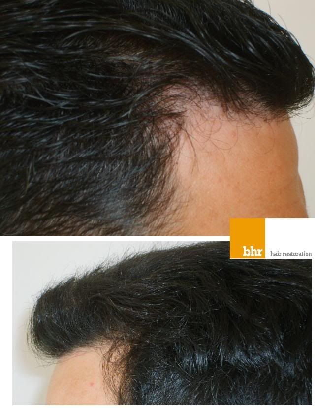 http://i156.photobucket.com/albums/t23/BHRClinic/1978%20FUE/178month-1.jpg