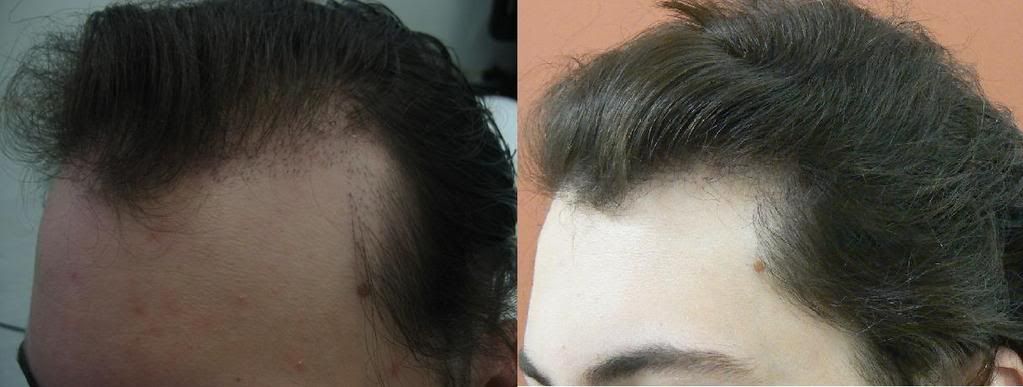 http://i156.photobucket.com/albums/t23/BHRClinic/2400%20FUE%20and%20170%20Plug%20Redistribution/1BeforeAfter.jpg