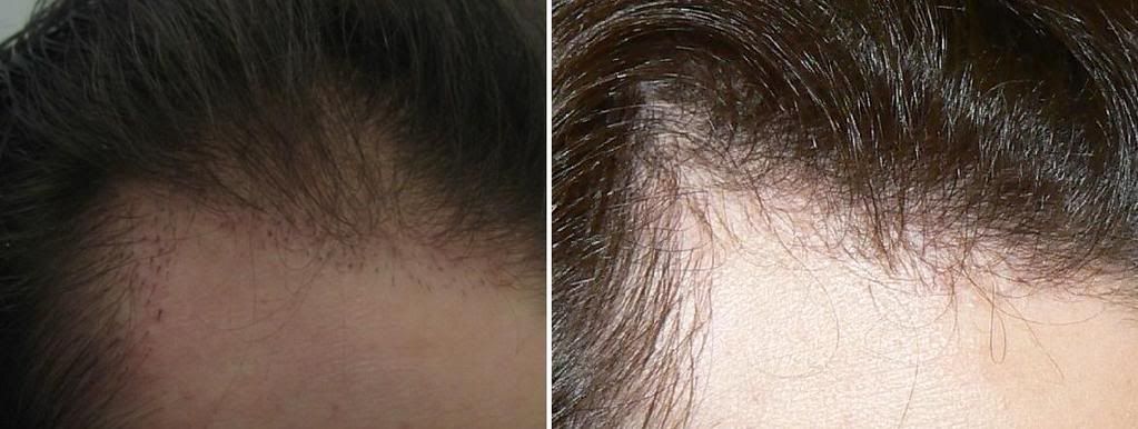 http://i156.photobucket.com/albums/t23/BHRClinic/2400%20FUE%20and%20170%20Plug%20Redistribution/2BeforeAfterTempleCloseUp.jpg