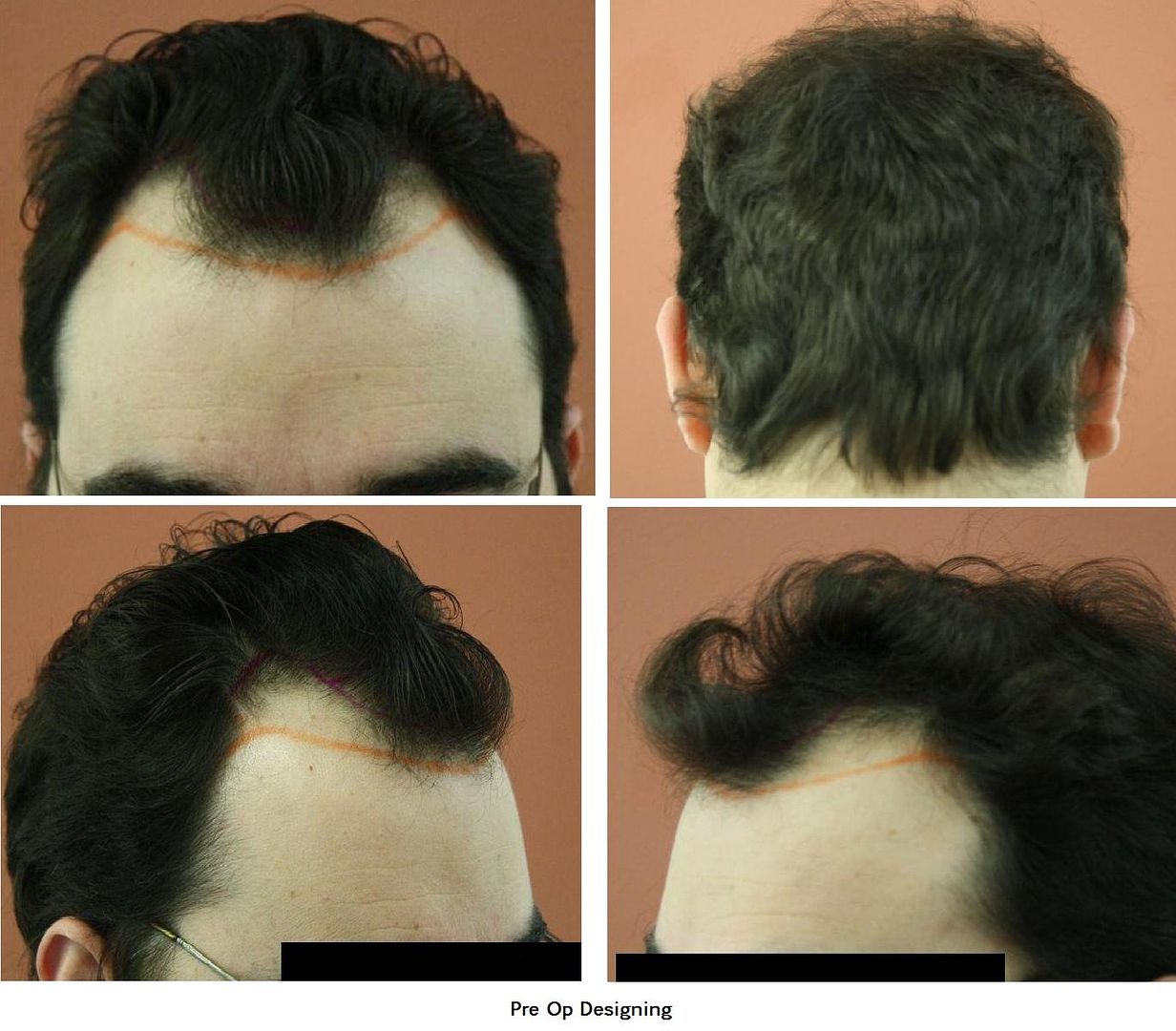 http://i156.photobucket.com/albums/t23/BHRClinic/2516%20%20%20FUE/PreOpDesigning.jpg