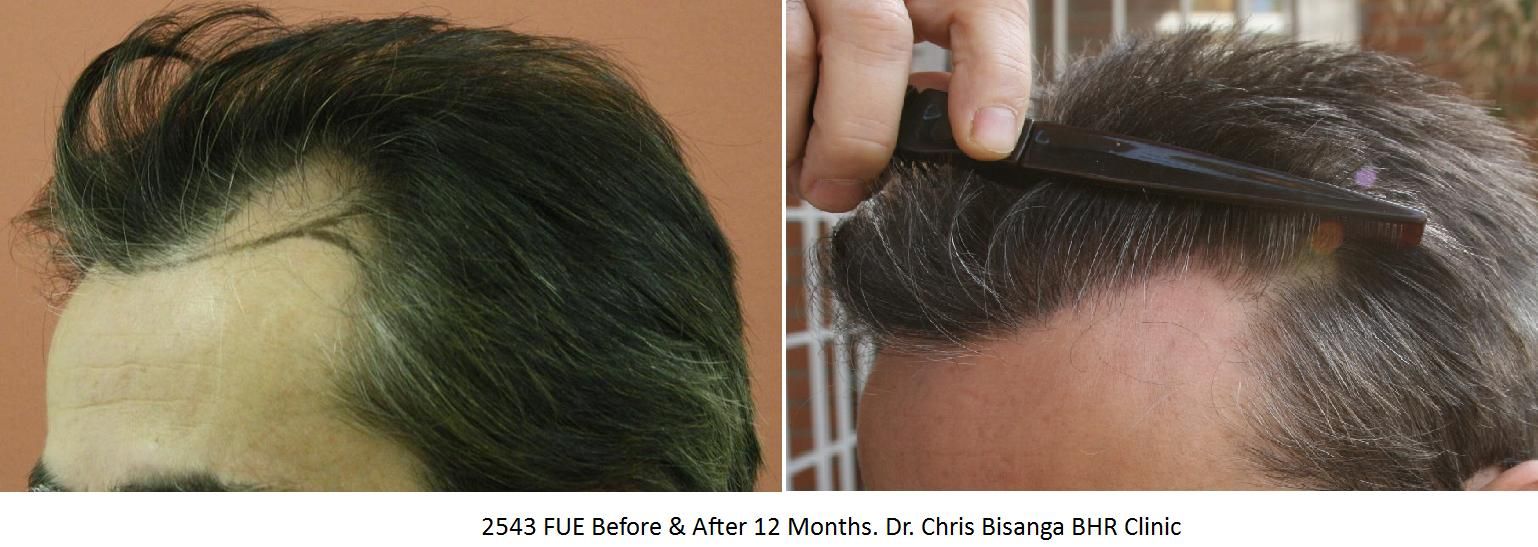 http://i156.photobucket.com/albums/t23/BHRClinic/2543%20FUE/42543FUEBeforeAfter12MonthsDrChrisB.jpg