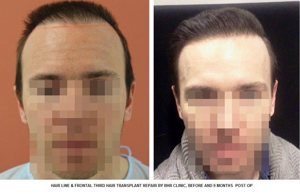 HAIRLINEFRONTALTHIRDHAIRTRANSPLANTREPAIRBYBHRCLINICBEFOREAND9MONTHSPOSTOP.jpg