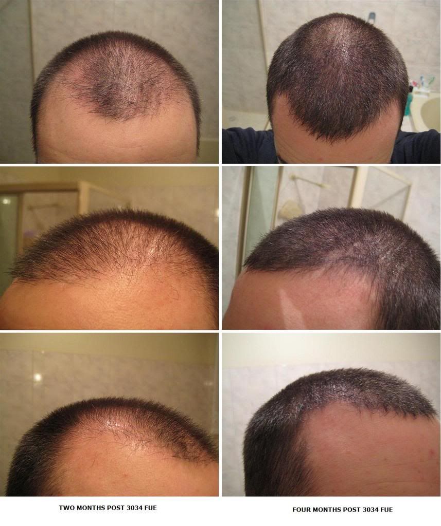 http://i156.photobucket.com/albums/t23/BHRClinic/3034%20FUE/2to4monthsPostOp3034FUE.jpg