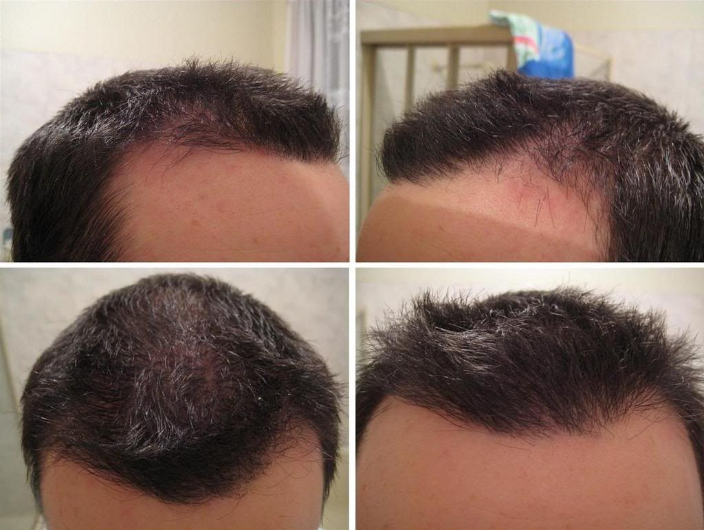 http://i156.photobucket.com/albums/t23/BHRClinic/3034%20FUE/5months2.jpg