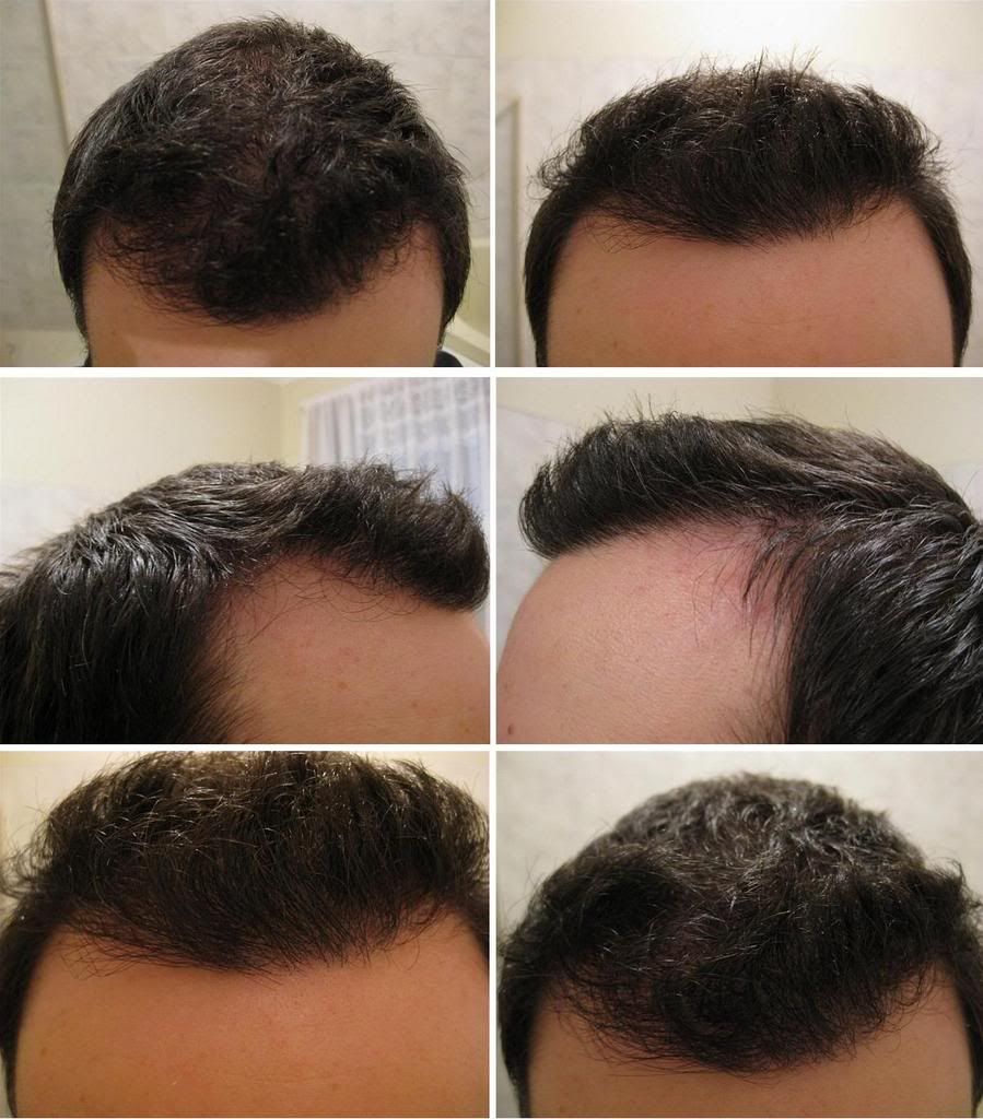 http://i156.photobucket.com/albums/t23/BHRClinic/3034%20FUE/AA6months.jpg