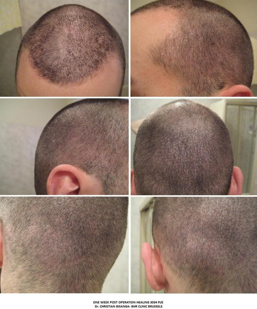 Hair Loss Forum