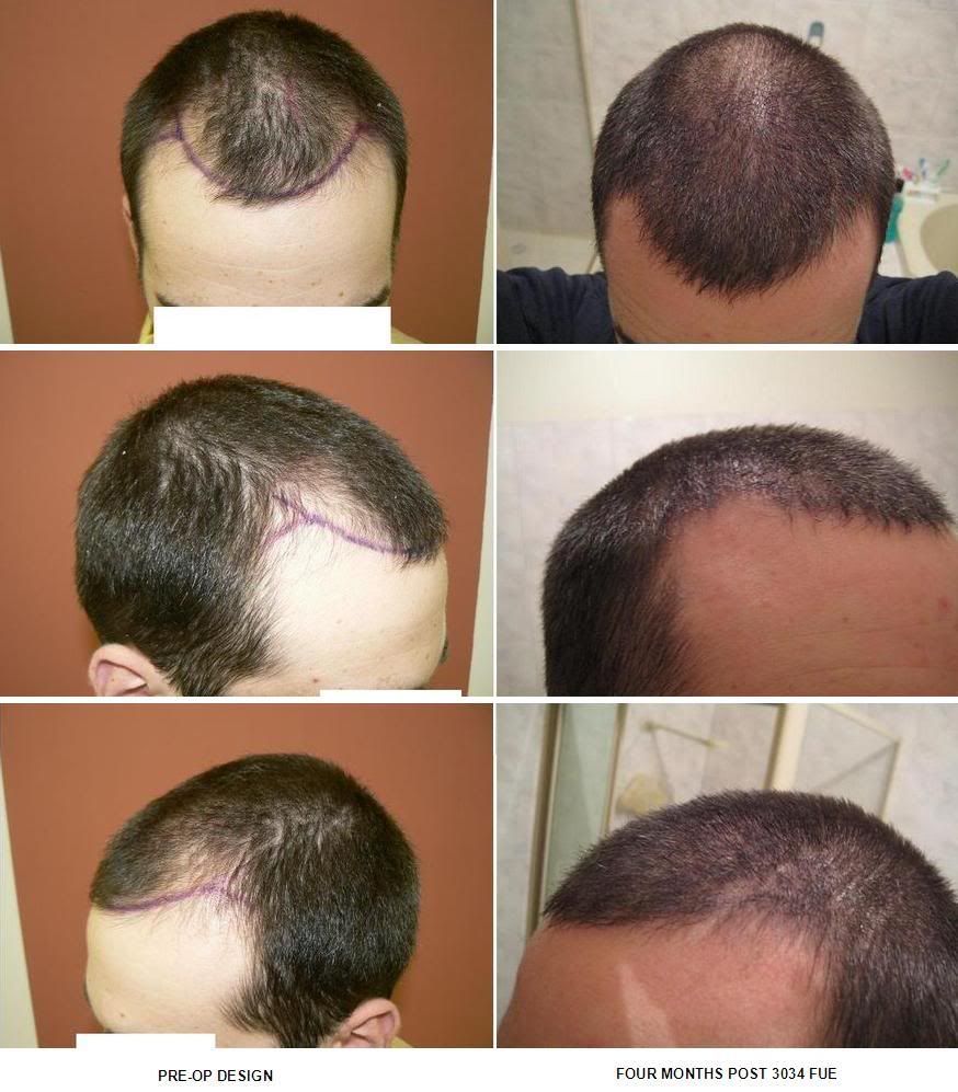 http://i156.photobucket.com/albums/t23/BHRClinic/3034%20FUE/PRE-OPDESIGNAND4MONTHS.jpg