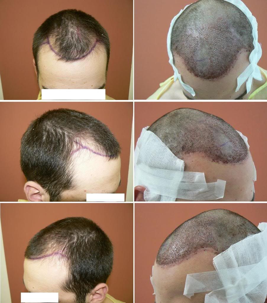 http://i156.photobucket.com/albums/t23/BHRClinic/3034%20FUE/PreOpDesignPostOpPlacement3034FUE.jpg