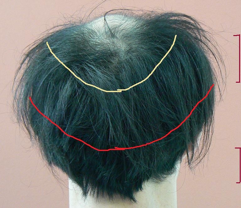hair photo:loss of hair 